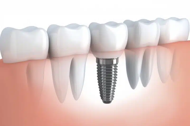 cấy ghép Implant NEOBiotech France cấy ghép Implant NEOBiotech France