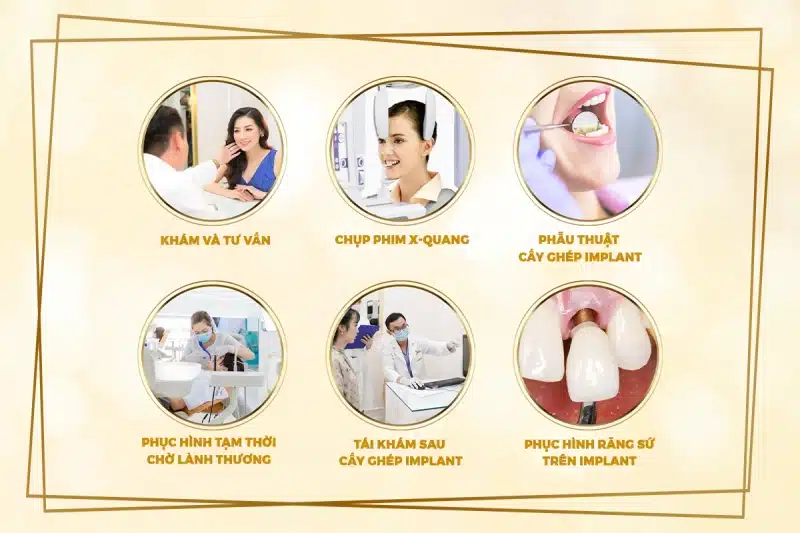 Quy trình thực hiện cấy ghép Implant NEOBiotech France Quy trình thực hiện cấy ghép Implant NEOBiotech France