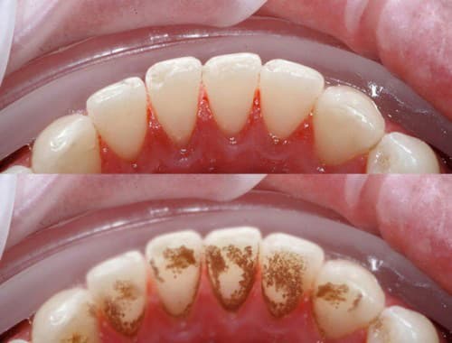 trước và sau khi lấy cao răng