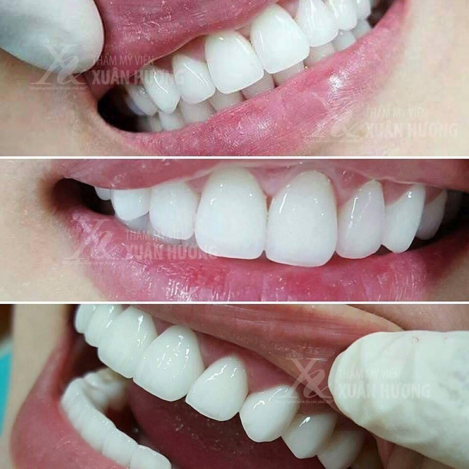 bọc răng sứ sinh học
