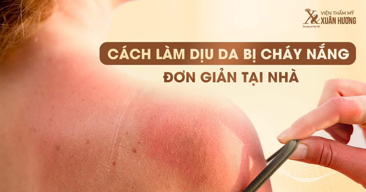 Cách làm dịu da chữa cháy nắng hiệu quả tại nhà