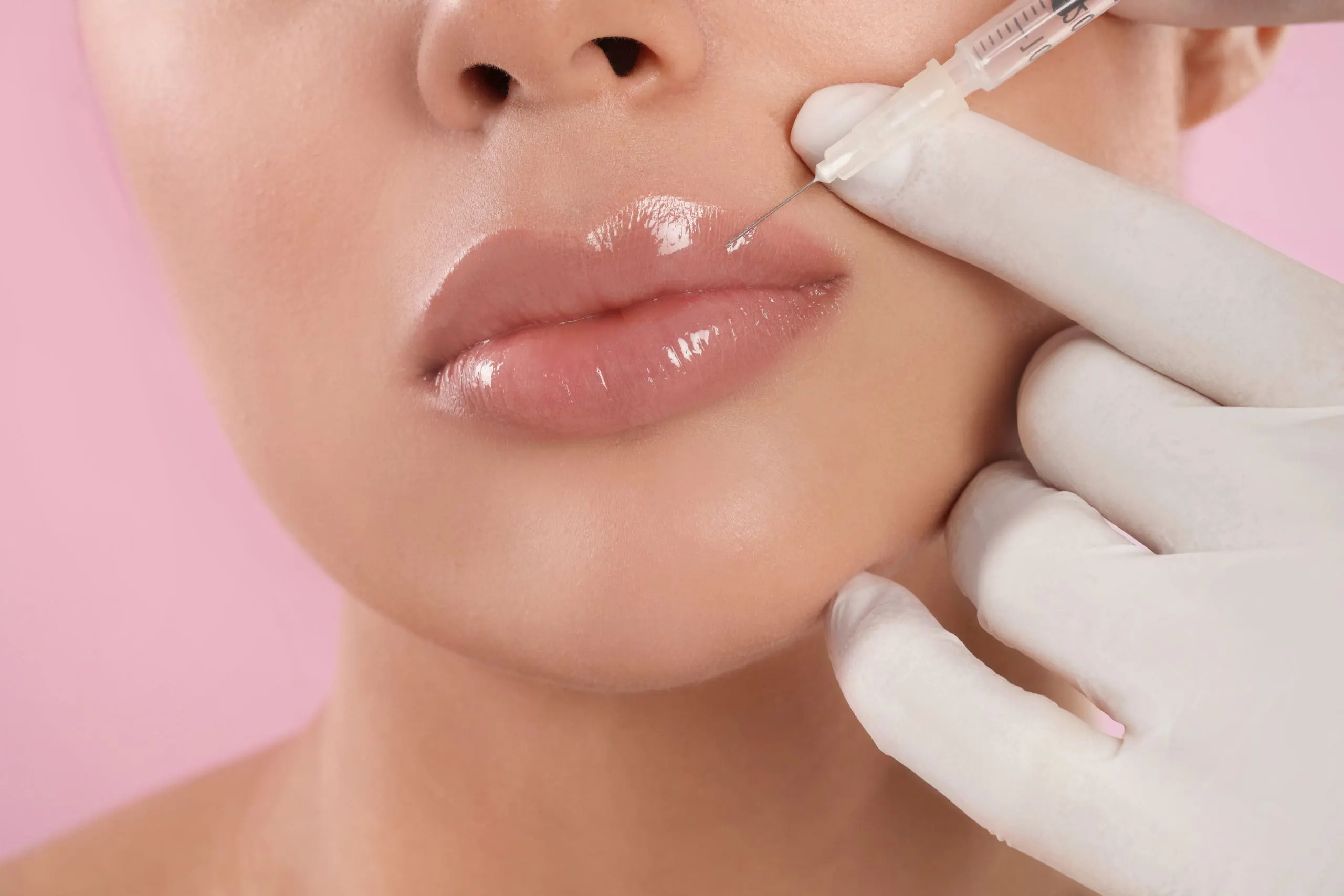 tiêm filler tạo hình môi cánh cung