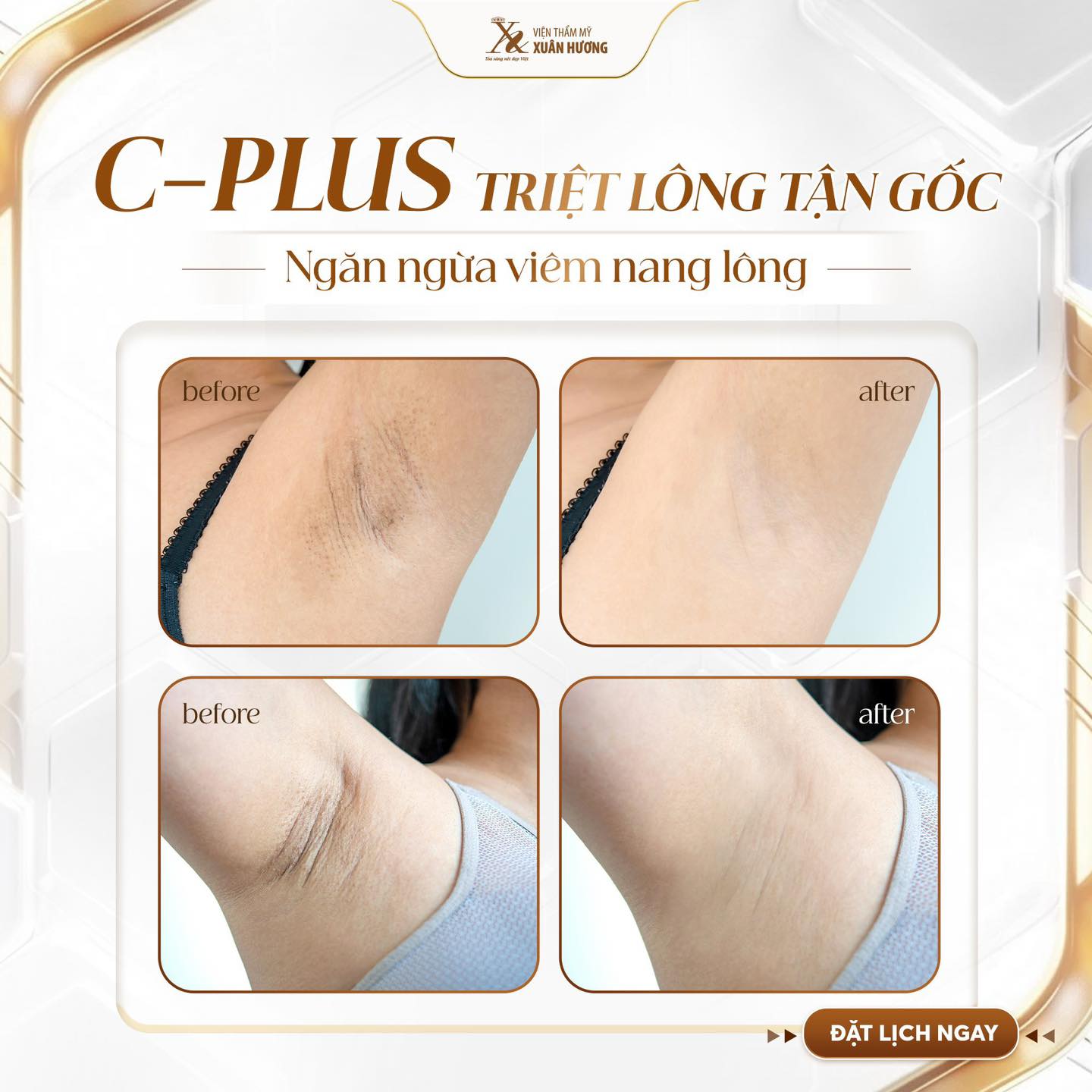 Những điều cần lưu ý trước và sau khi triệt lông