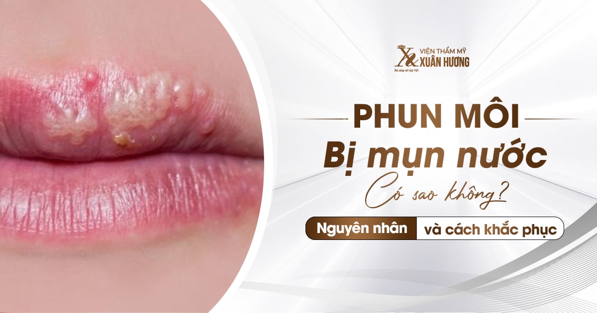 phun môi xong bị mụn nước