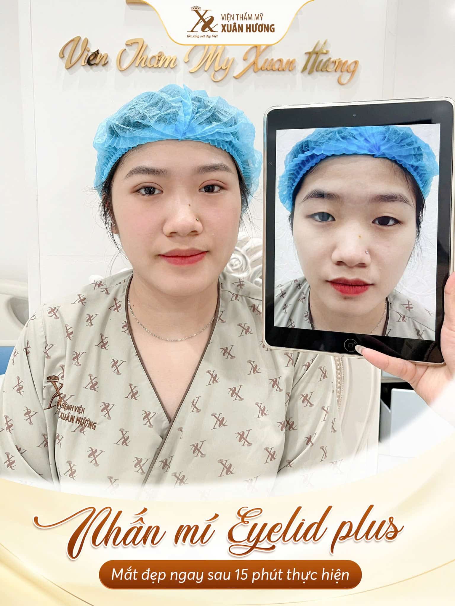 nhấn mí mắt eye plus