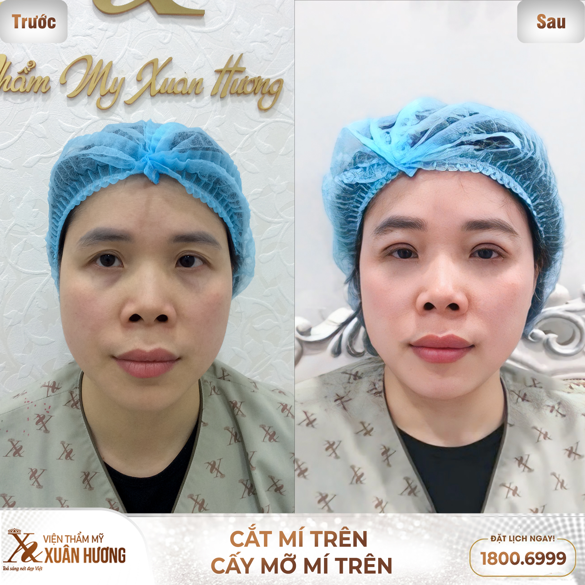 kết quả cắt mí trên tại xuân hương