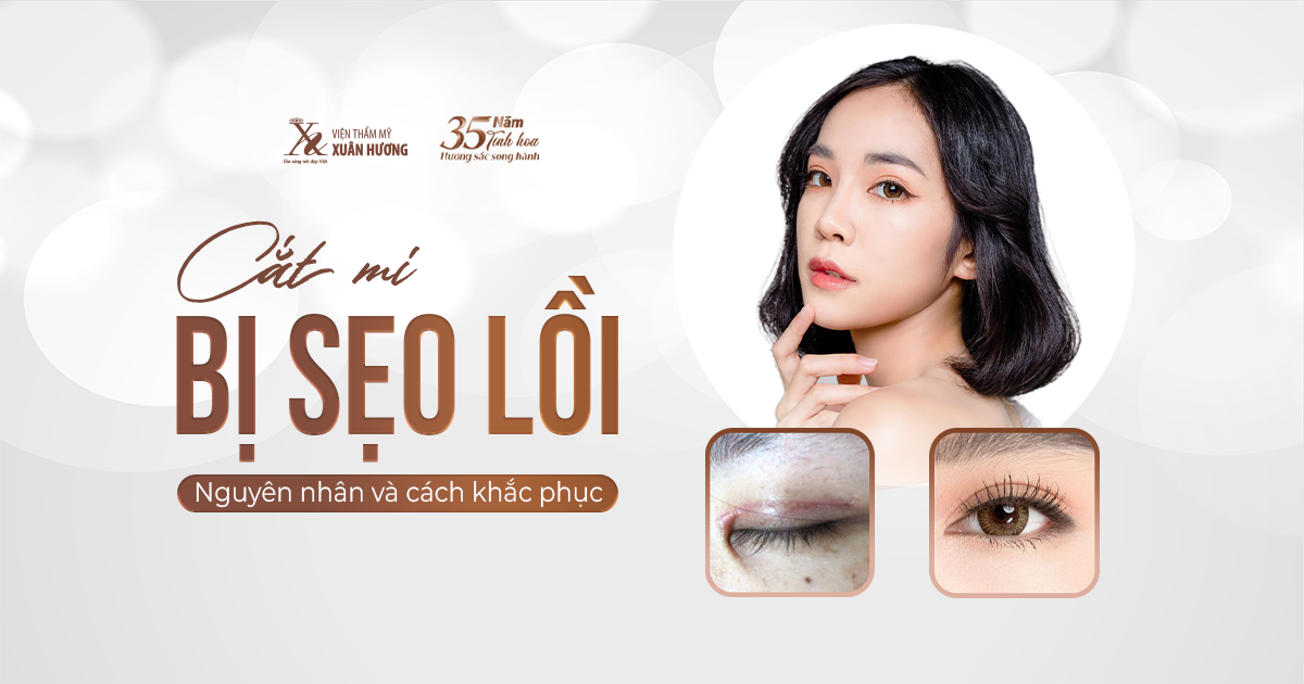 cắt mí mắt bị sẹo lồi