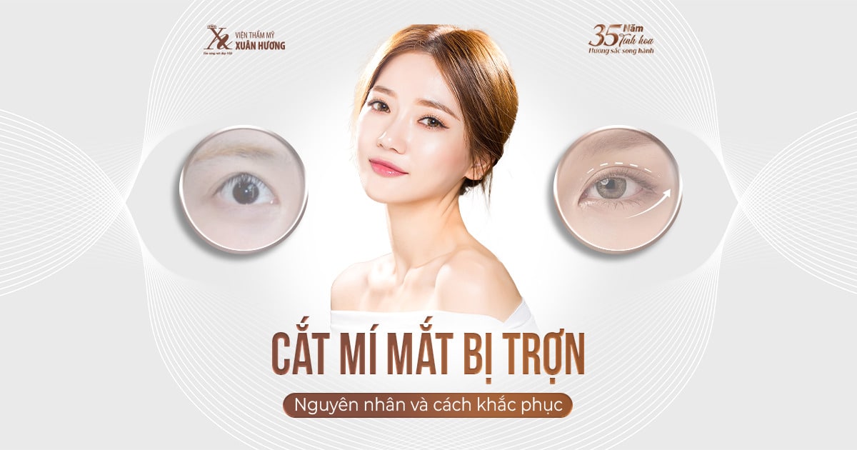 Cắt mí mắt bị trợn