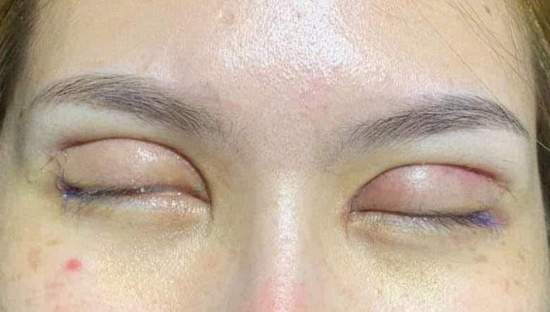 cắt mí mắt bị sâu không nhắm được mắt