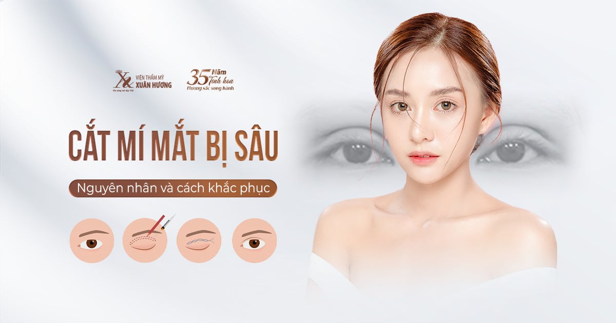 Cắt Mí Mắt Bị Sâu