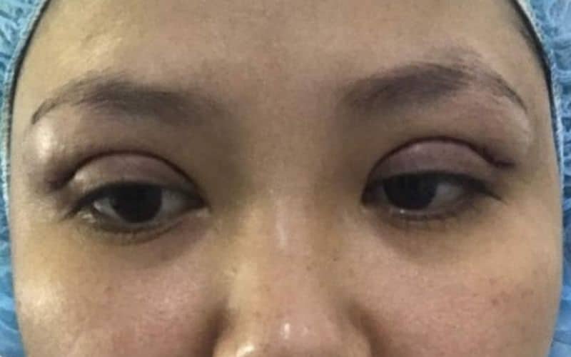 hình ảnh cắt mí mắt bị sâu thiếu thẩm mỹ