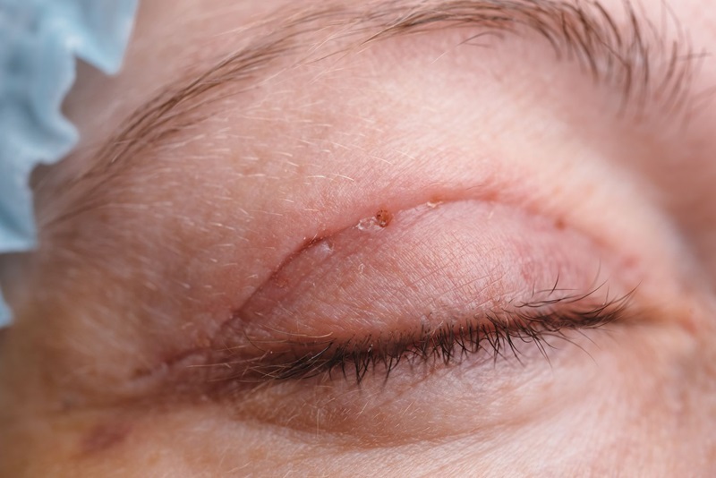 cắt mí mắt để lại sẹo