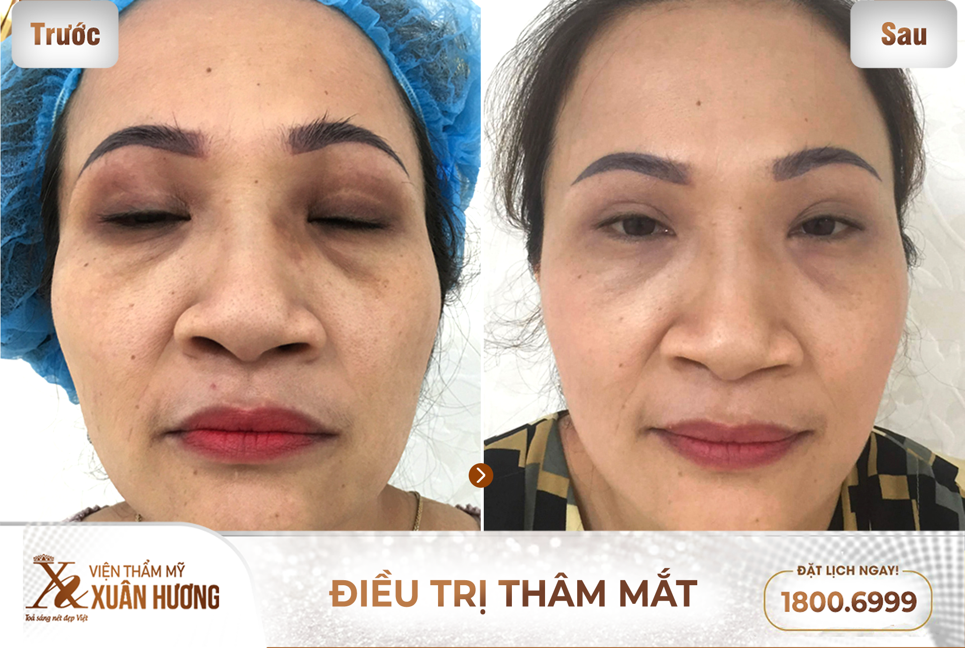 khử thâm mắt đúng cách và an toàn