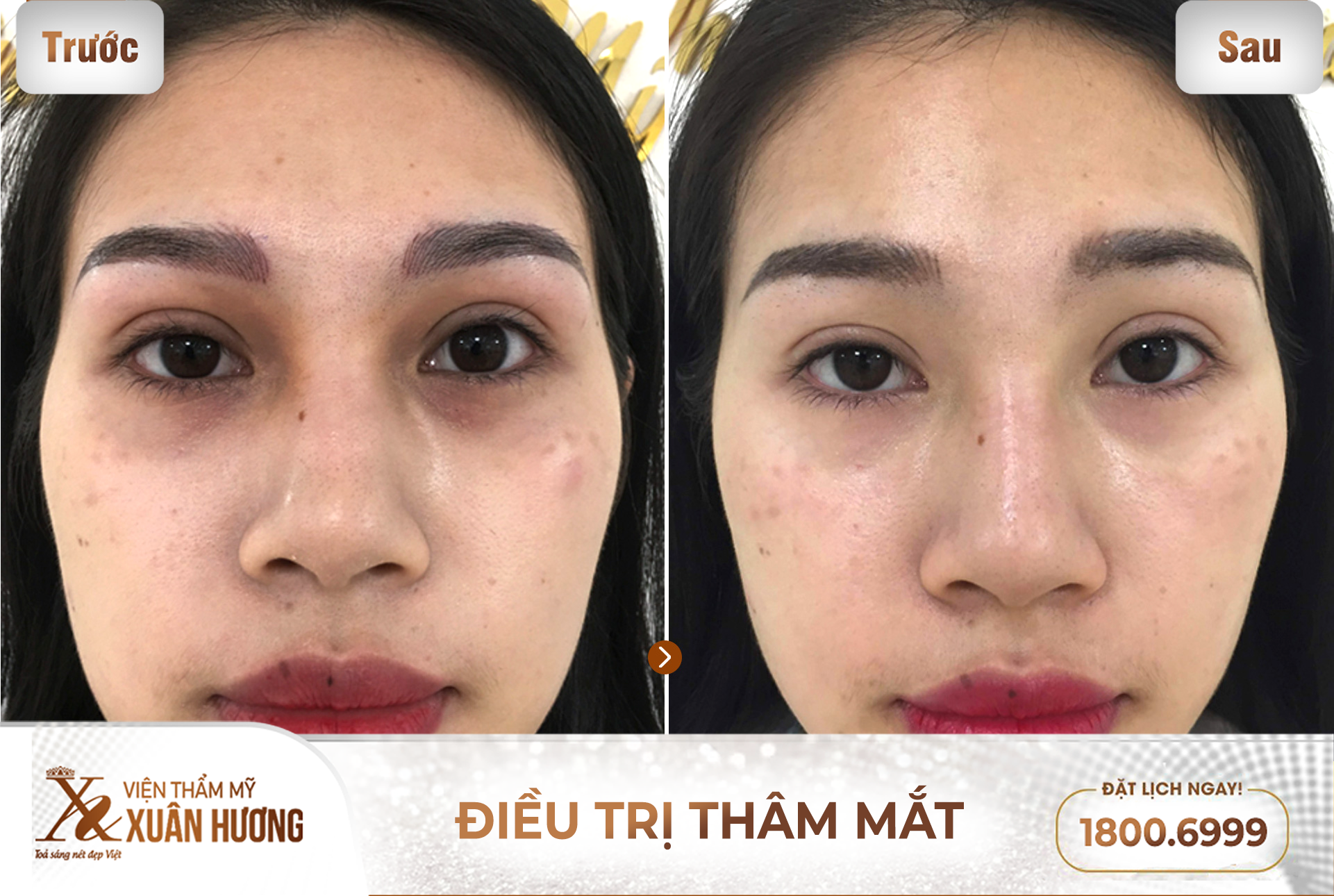 khử thâm mắt đúng cách và an toàn