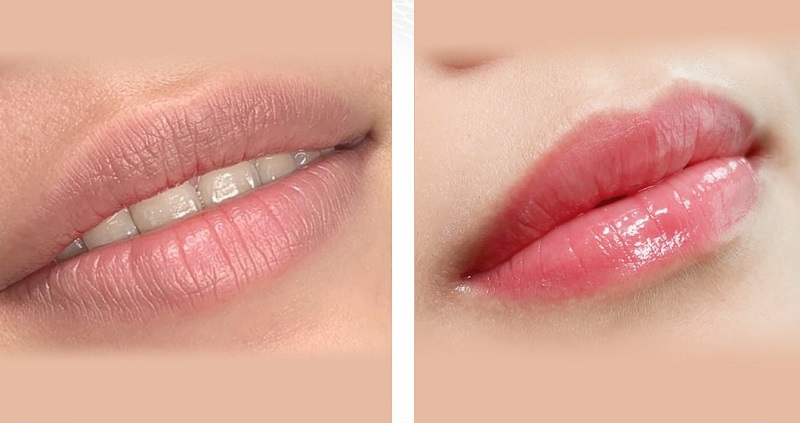 Một số lưu ý cần biết trước và sau khi khử thâm môi