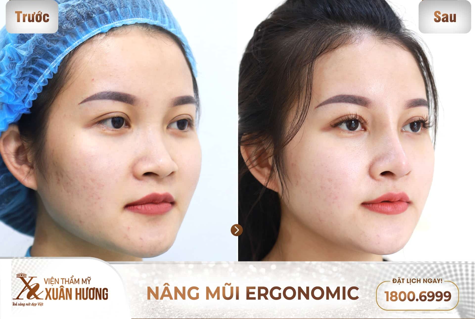 nâng mũi Ergonomic đẹp tự nhiên