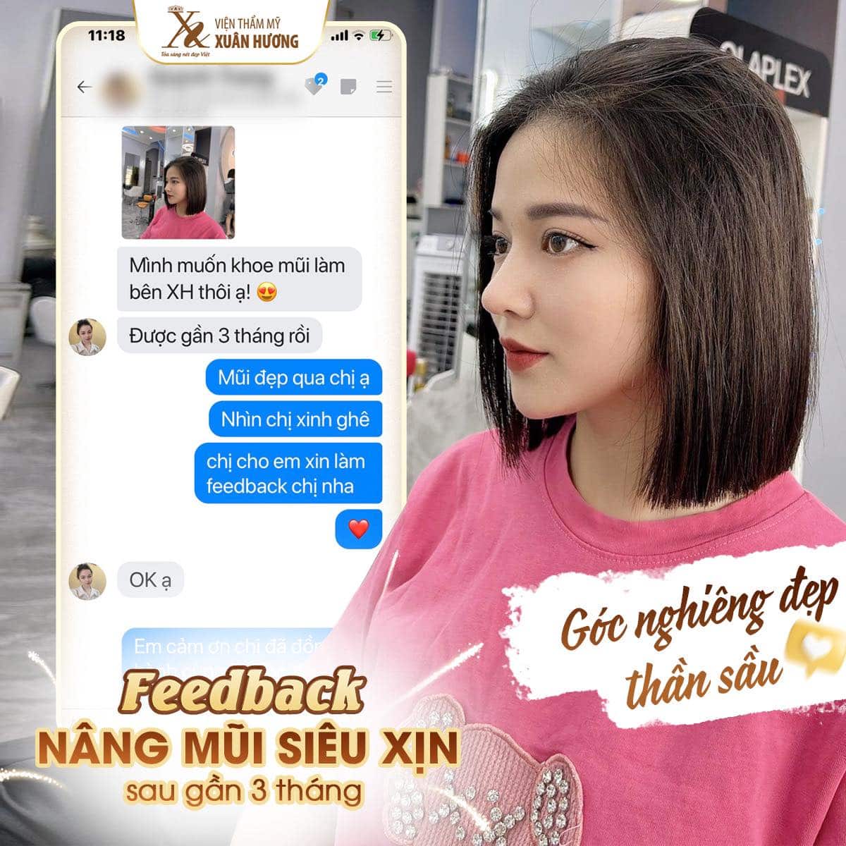 nâng mũi Ergonomic đẹp tự nhiên