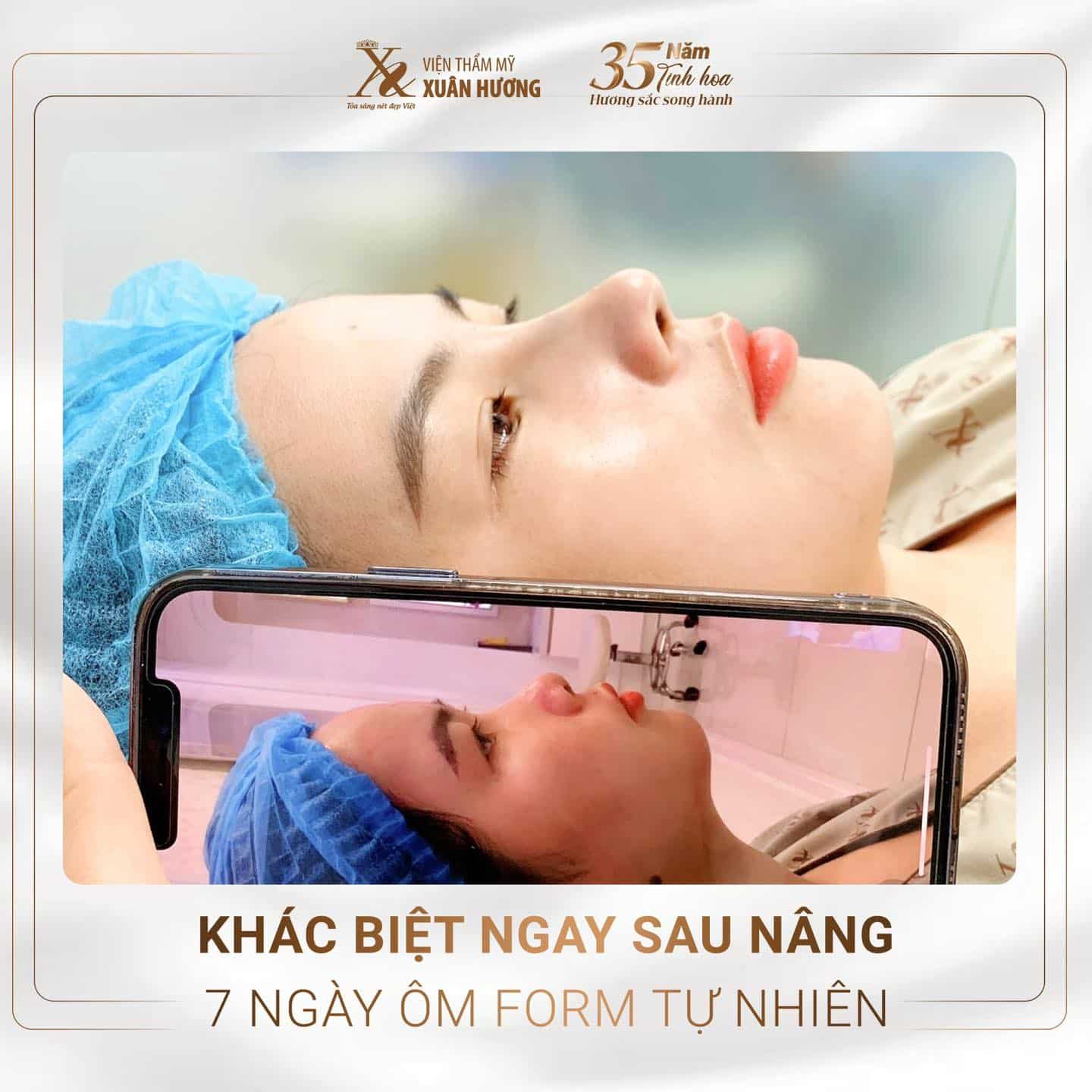 nâng mũi Ergonomic đẹp tự nhiên