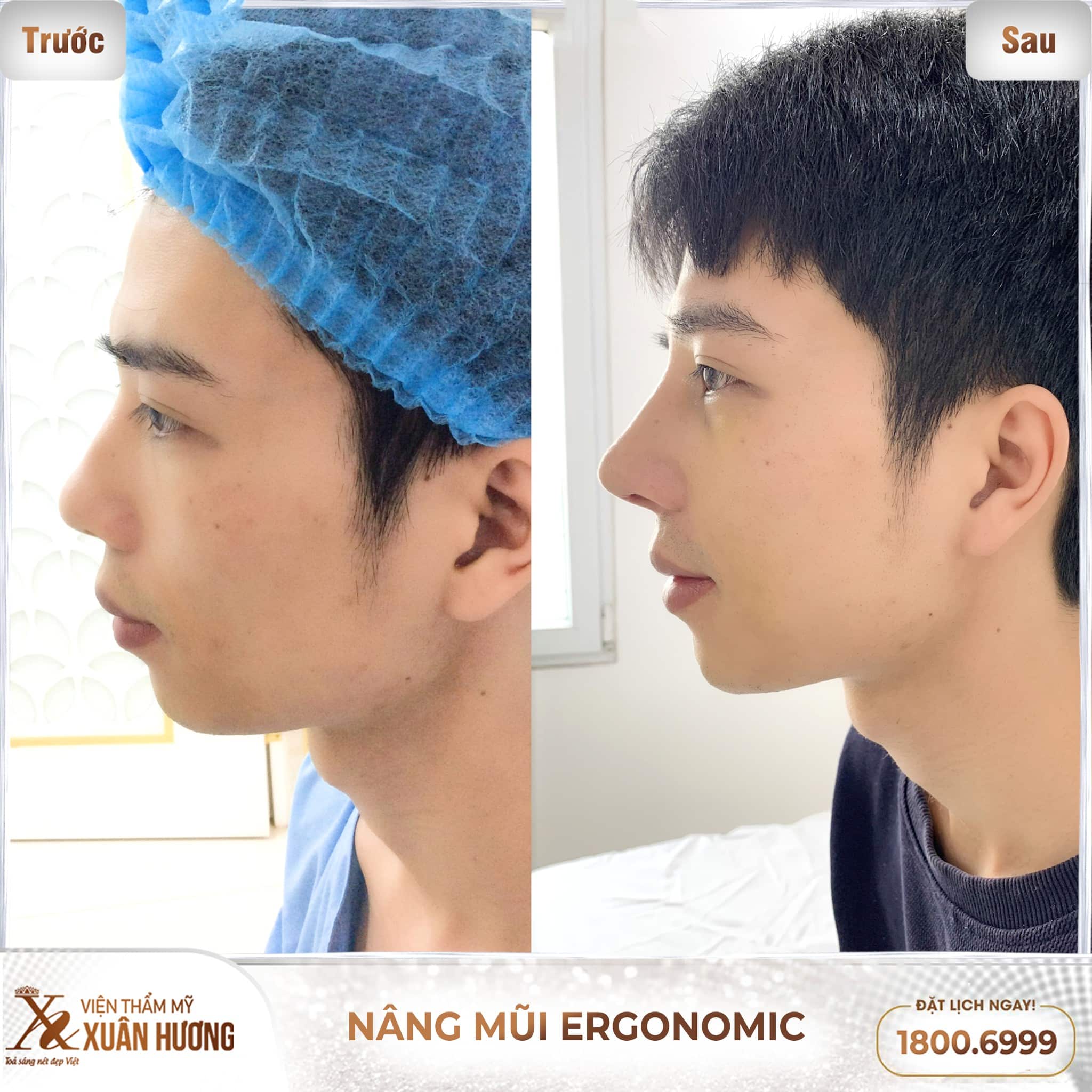 nâng mũi Ergonomic đẹp tự nhiên