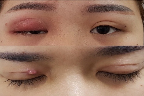 Nguyên nhân khiến mí mắt bị sẹo lồi sau cắt mí