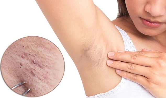 Những thói quen vô tình có thể khiến nách bị thâm