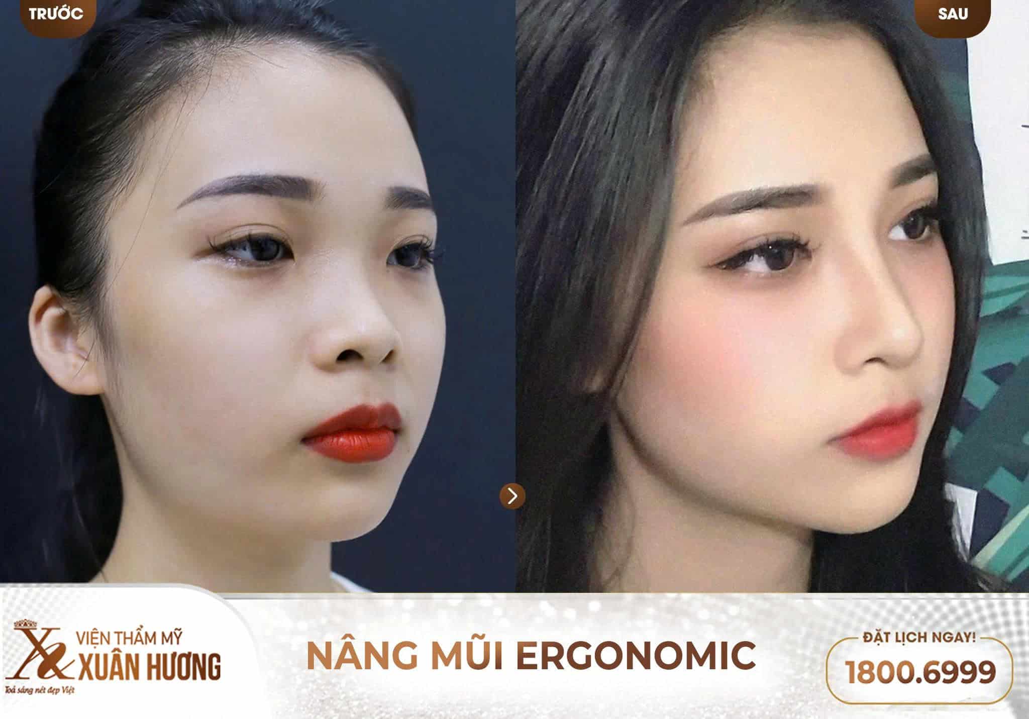 nâng mũi Ergonomic đẹp tự nhiên