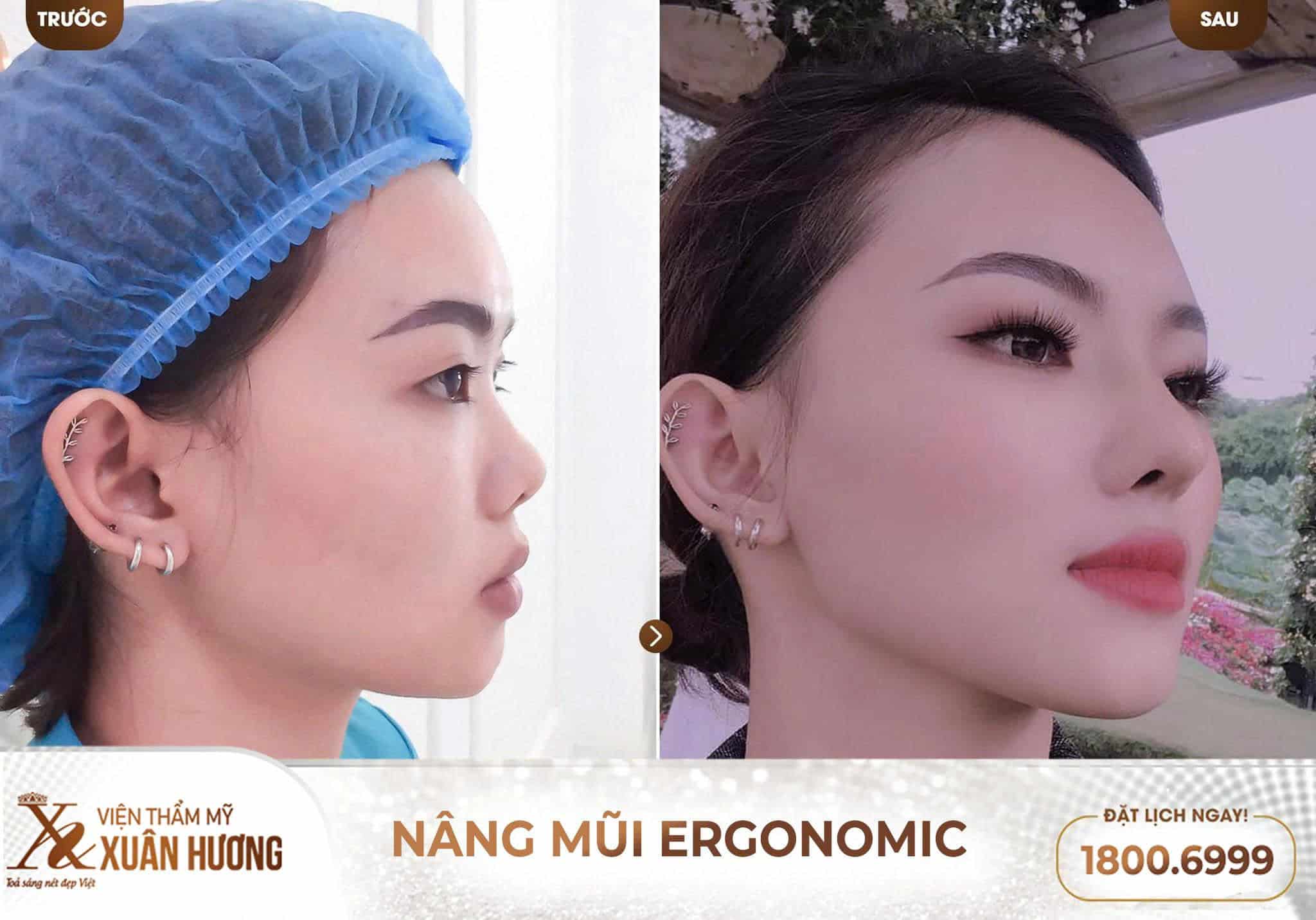 nâng mũi Ergonomic đẹp tự nhiên