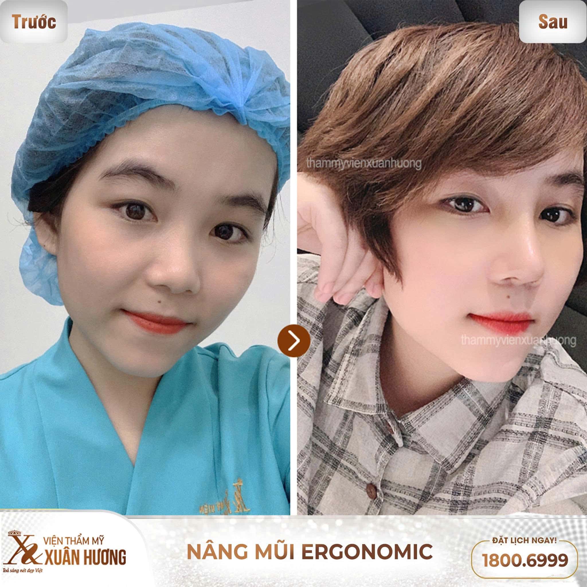 nâng mũi Ergonomic đẹp tự nhiên