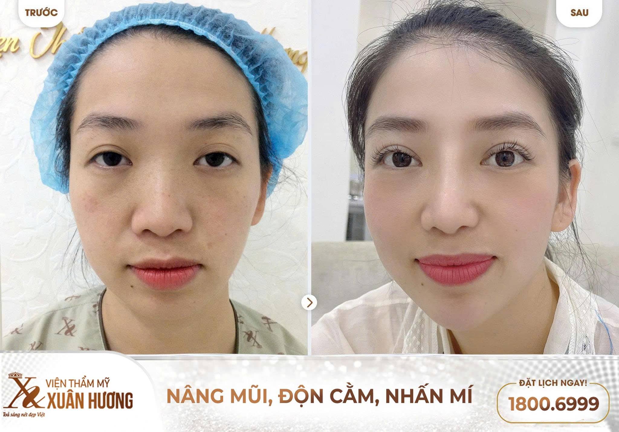 nâng mũi Ergonomic đẹp tự nhiên