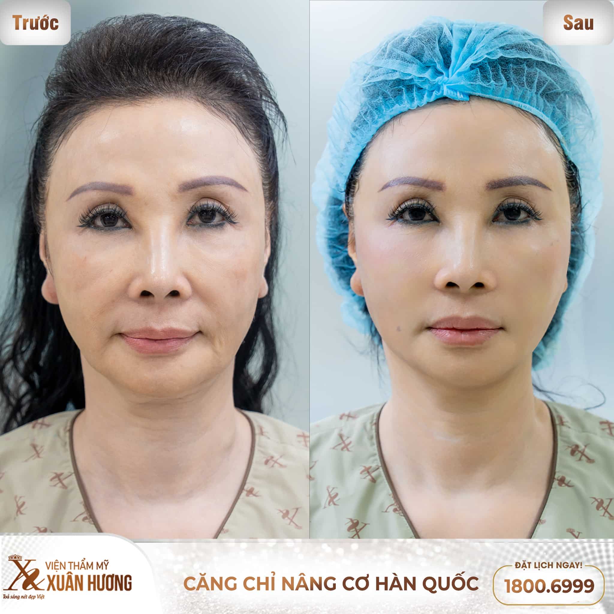 Khách hàng trước và sau khi căng chỉ