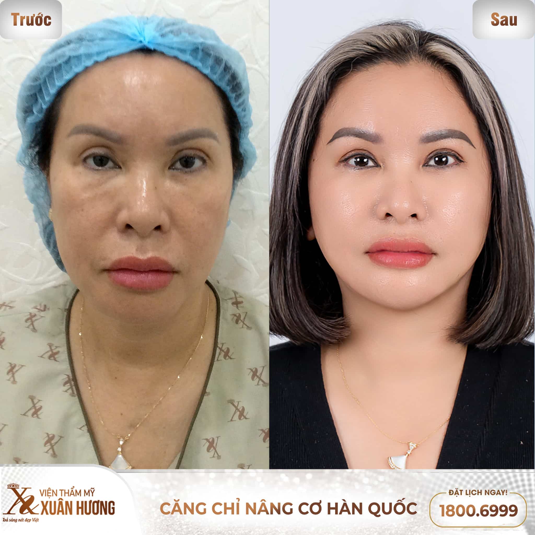 Khách hàng trước và sau khi căng chỉ
