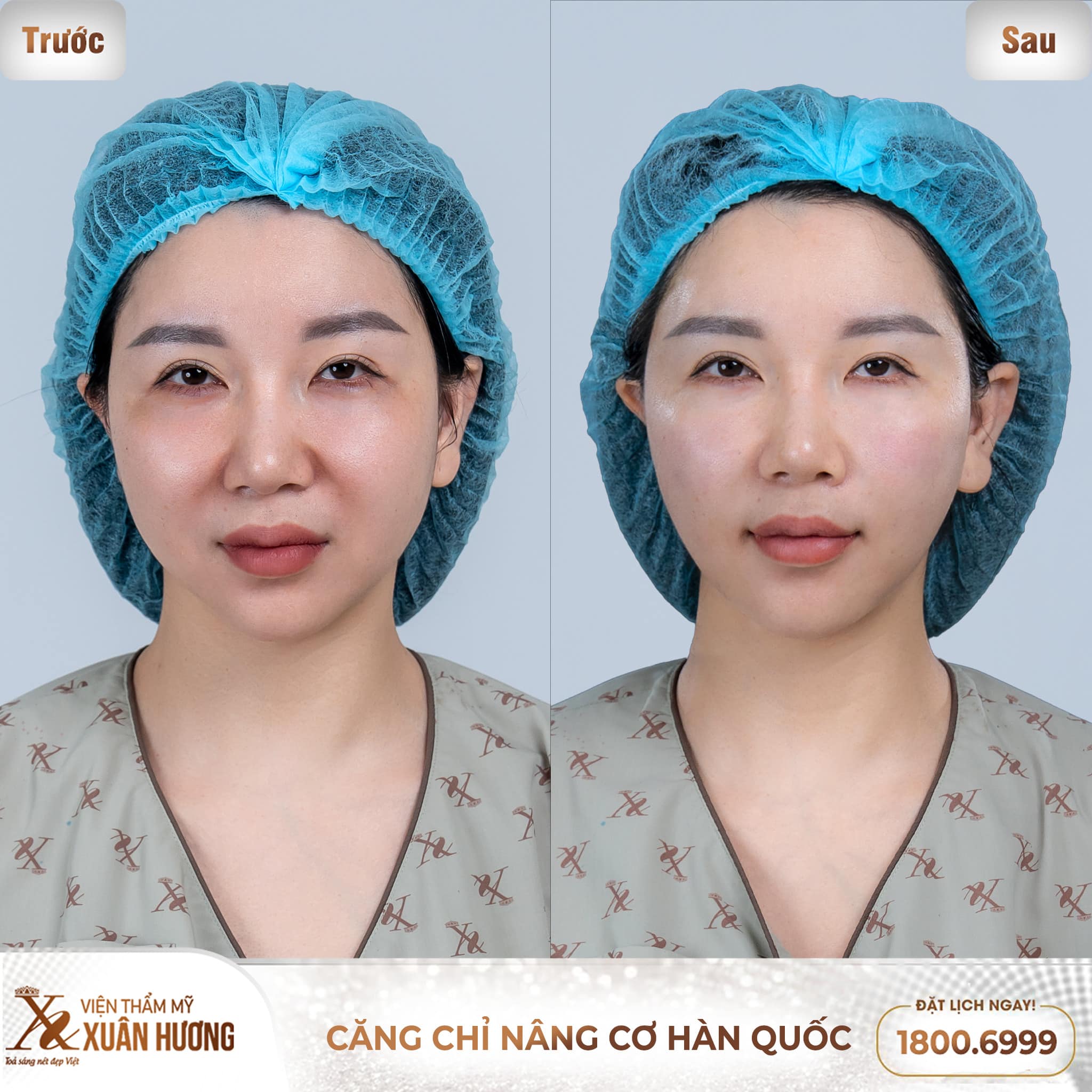 Khách hàng trước và sau khi căng chỉ