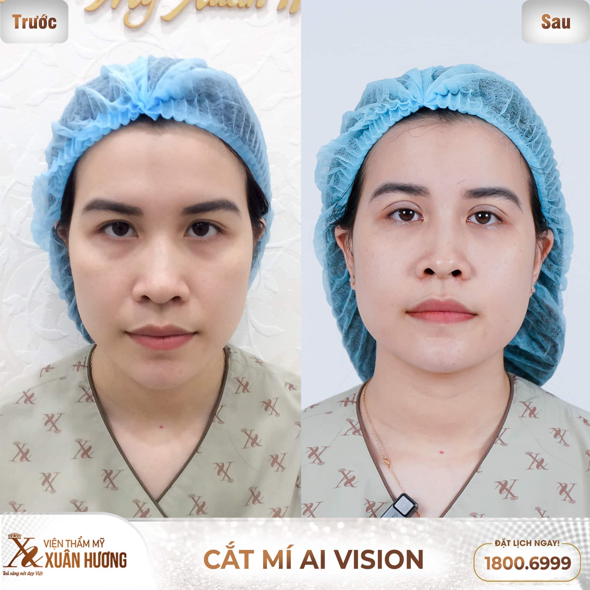 Hình ảnh khách hàng trước và sau khi cắt mí AI Vision