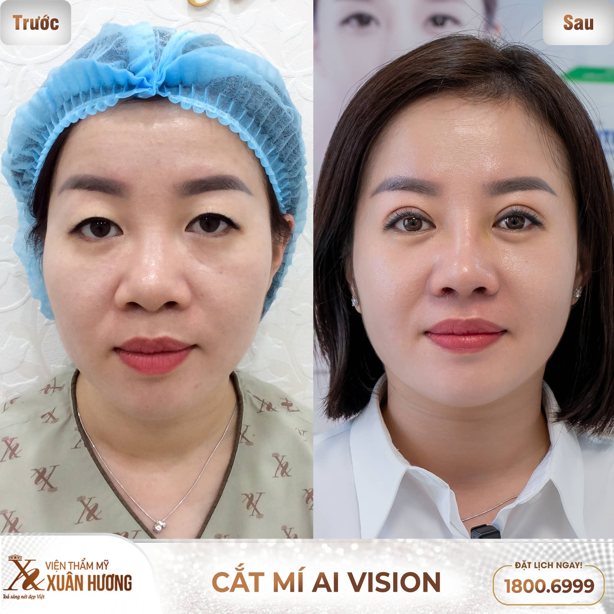 Hình ảnh khách hàng trước và sau khi cắt mí AI Vision