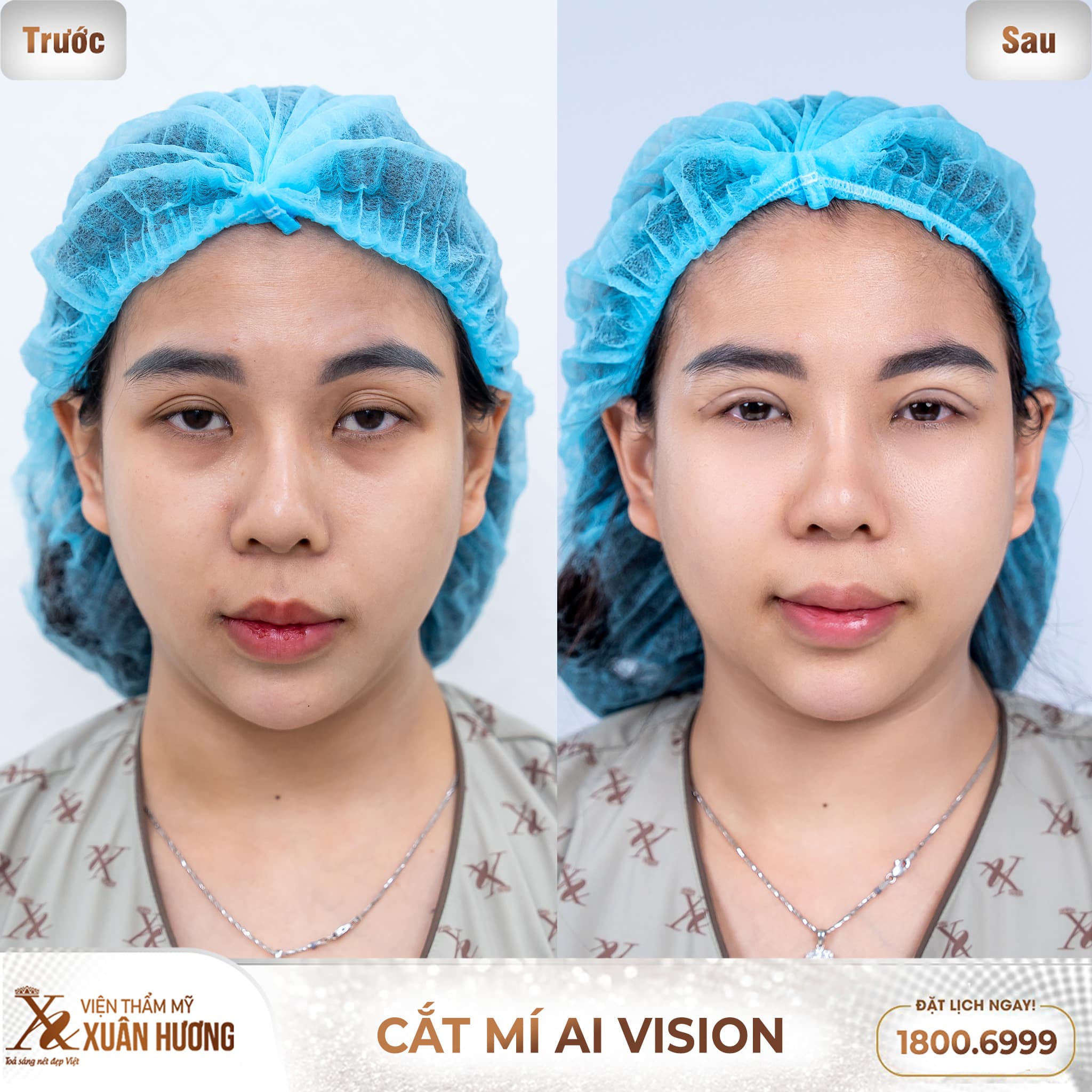 Hình ảnh khách hàng trước và sau khi cắt mí AI Vision