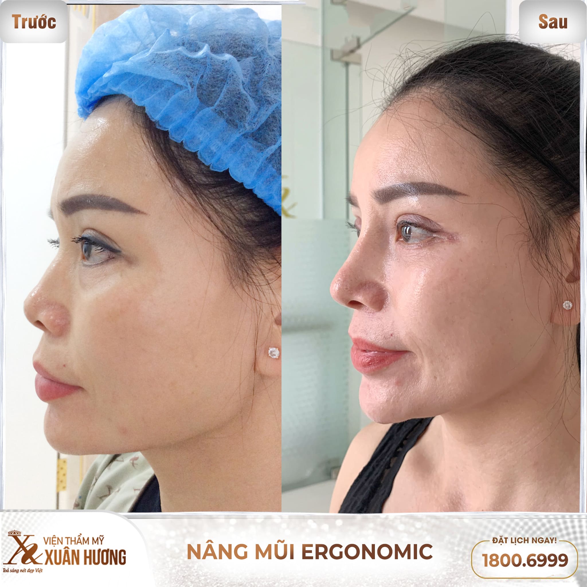 khách hàng nâng mũi