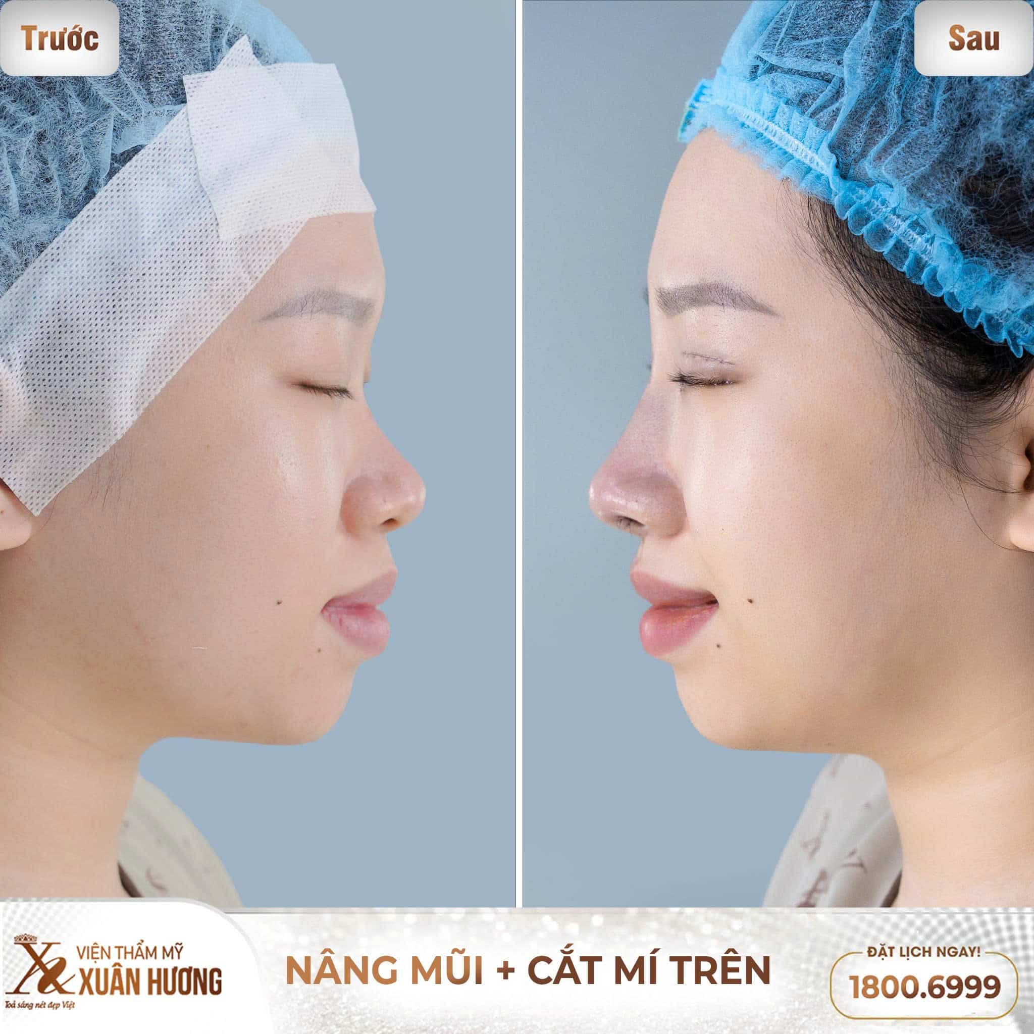 Nâng Mũi Phong Thủy – Chọn Dáng Mũi Hợp Tướng, Đón Tài Lộc