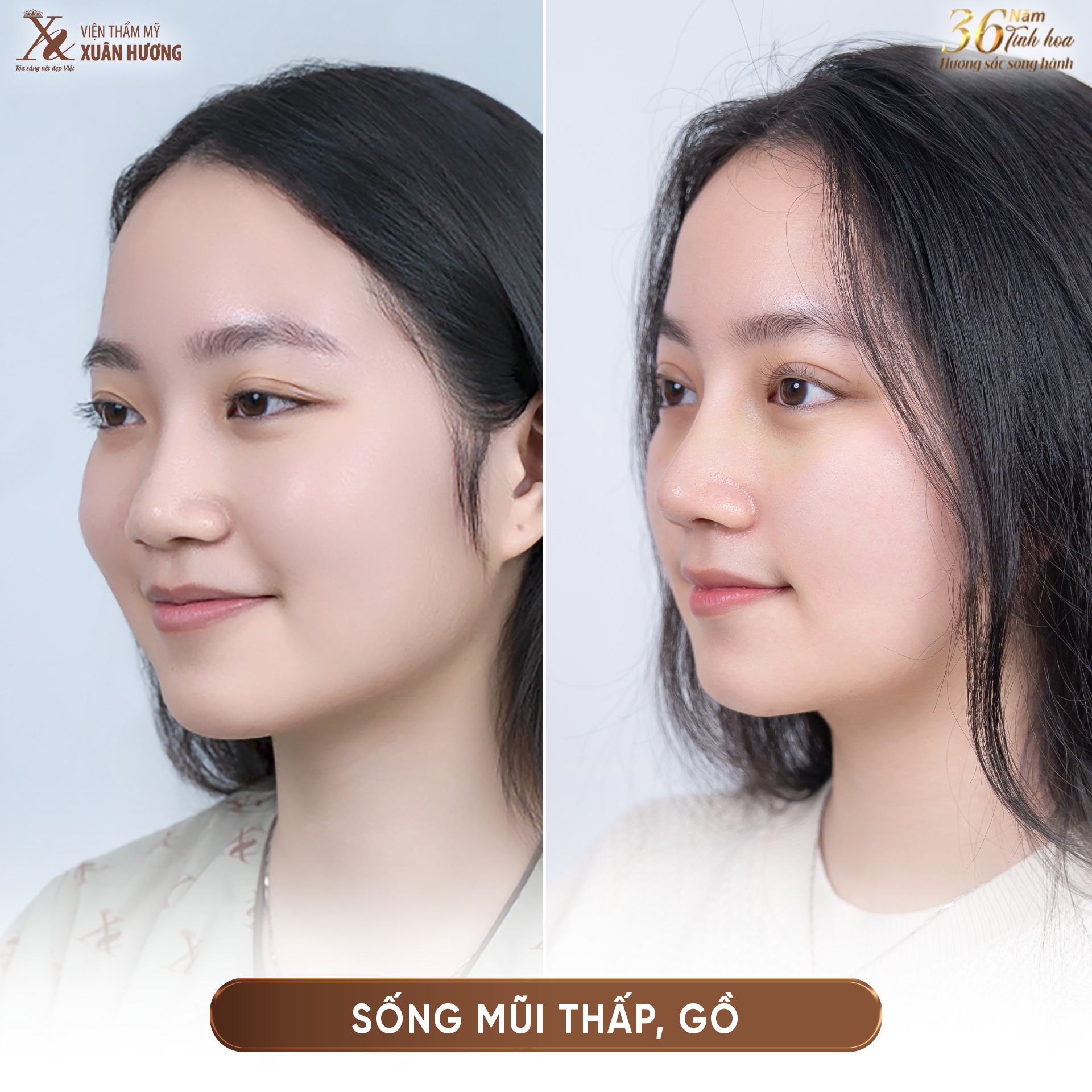 nâng mũi phong thủy đẹp