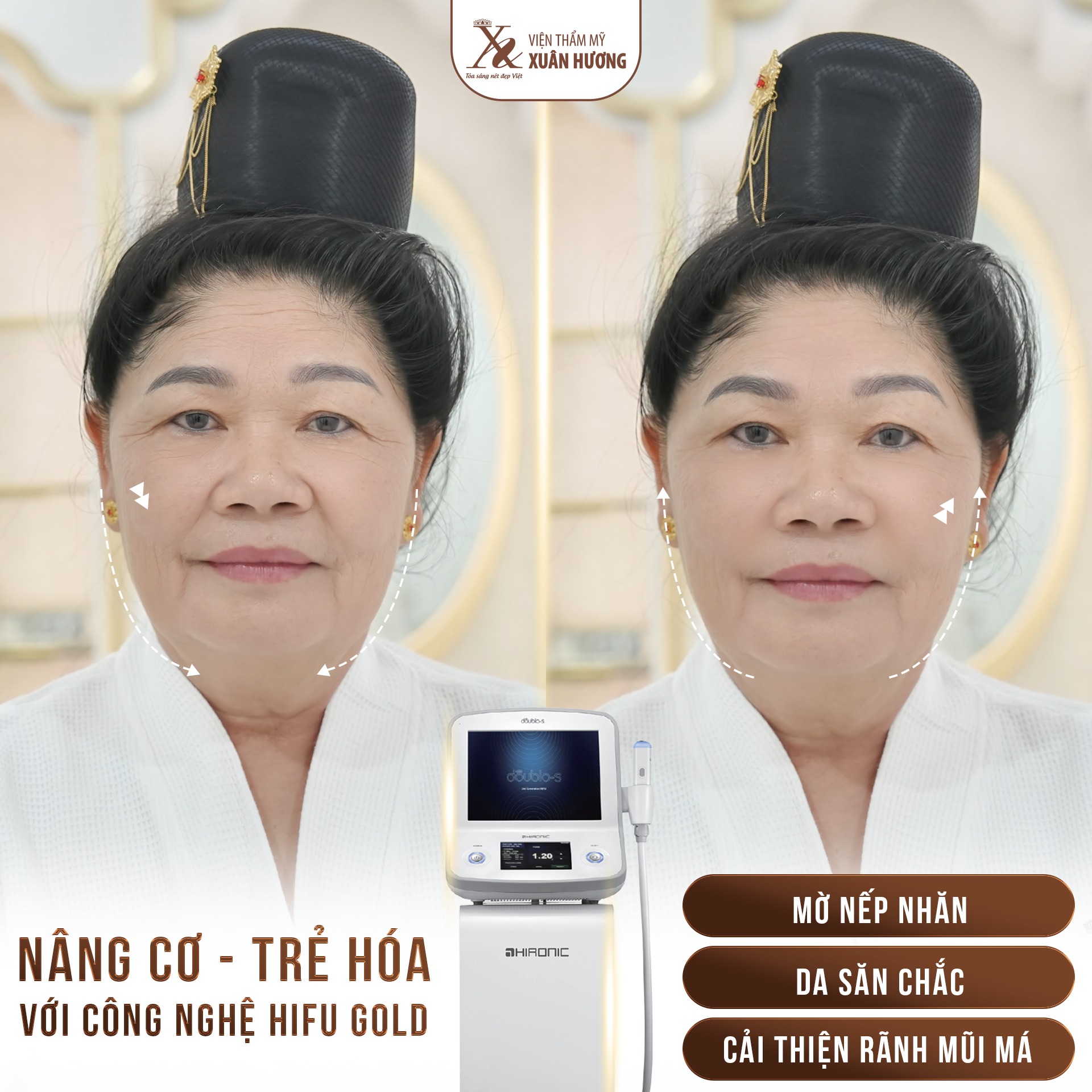 Trẻ hóa da bằng công nghệ Hifu – Giải pháp trẻ hóa da không phẫu thuật