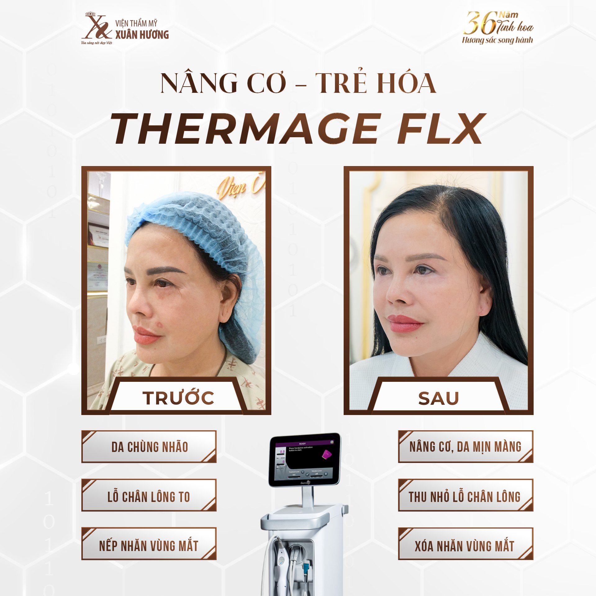 Thermage flx xóa nhăn vùng da mắt hiệu quả