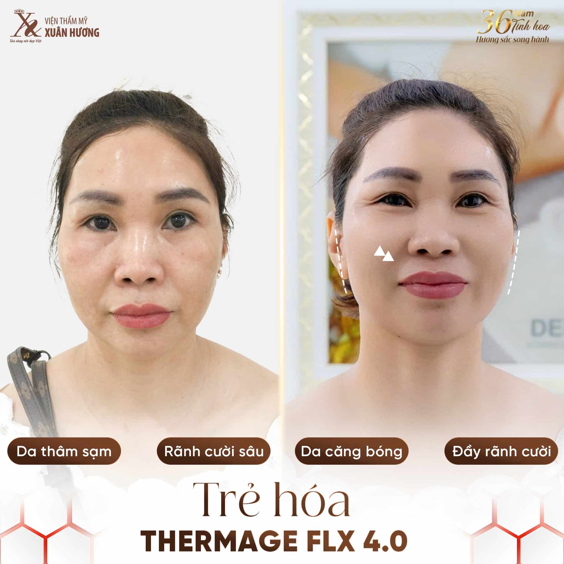 trẻ hóa da thermage FLX 4.0 da căng bóng