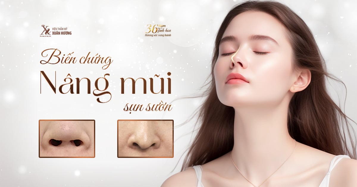 biến chứng nâng mũi sụn sường