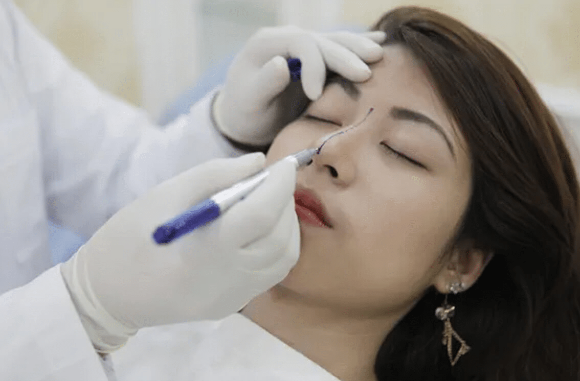 nâng mũi sụn sườn biến chứng