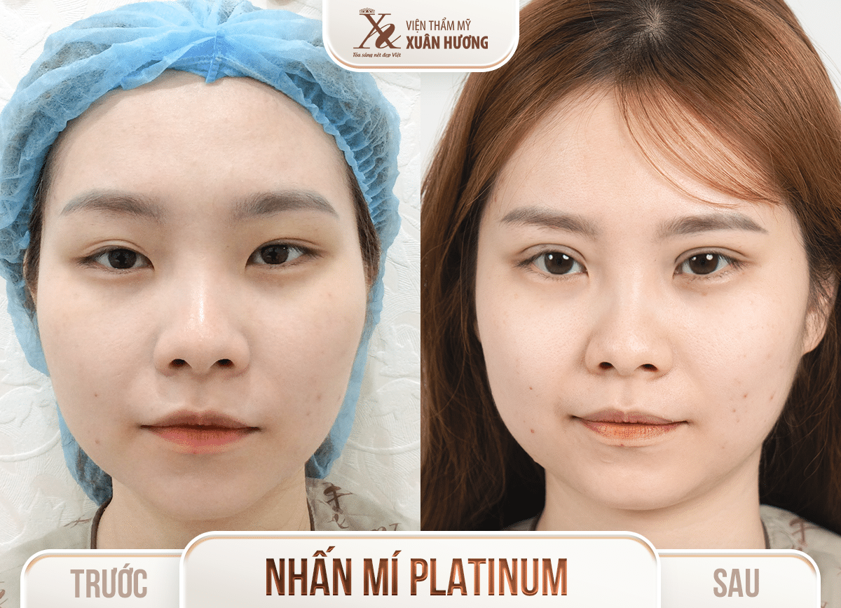 Ảnh trước sau – Phẫu thuật thẩm mỹ