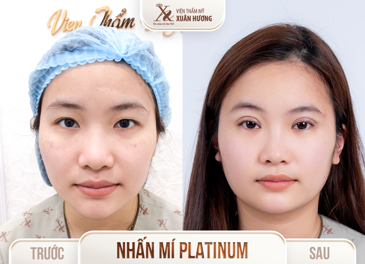 Ảnh trước sau – Phẫu thuật thẩm mỹ