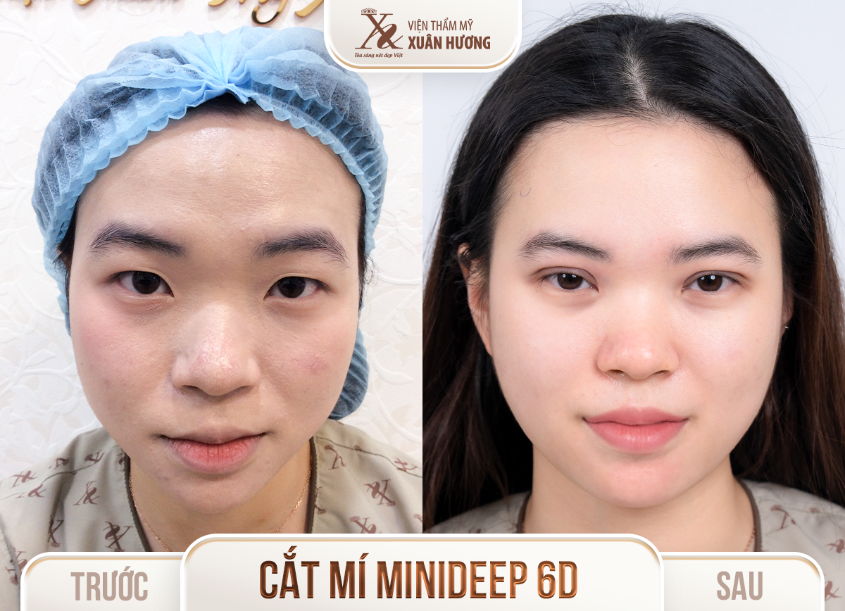 Ảnh trước sau – Phẫu thuật thẩm mỹ