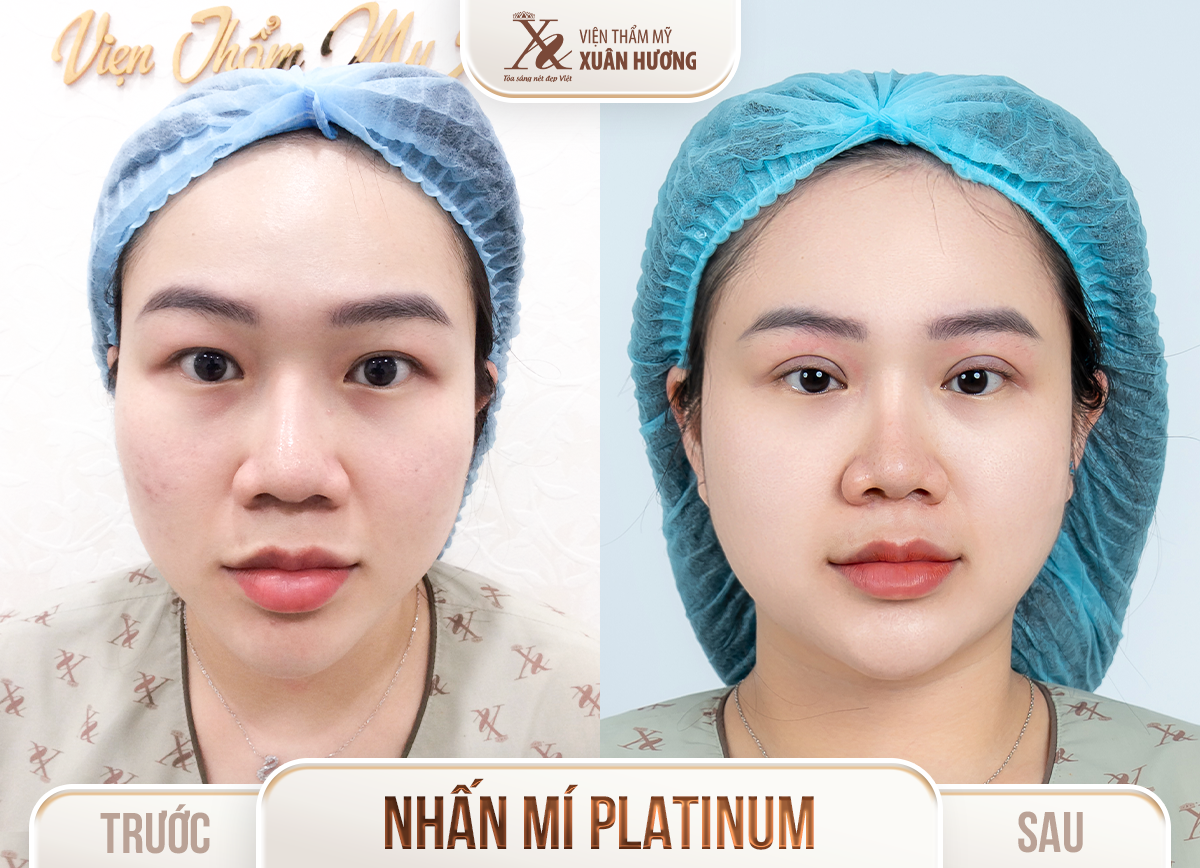 Ảnh trước sau – Phẫu thuật thẩm mỹ