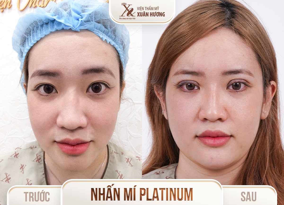Ảnh trước sau – Phẫu thuật thẩm mỹ