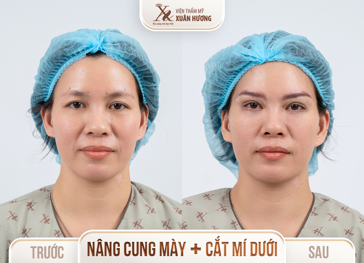 Ảnh trước sau – Phẫu thuật thẩm mỹ