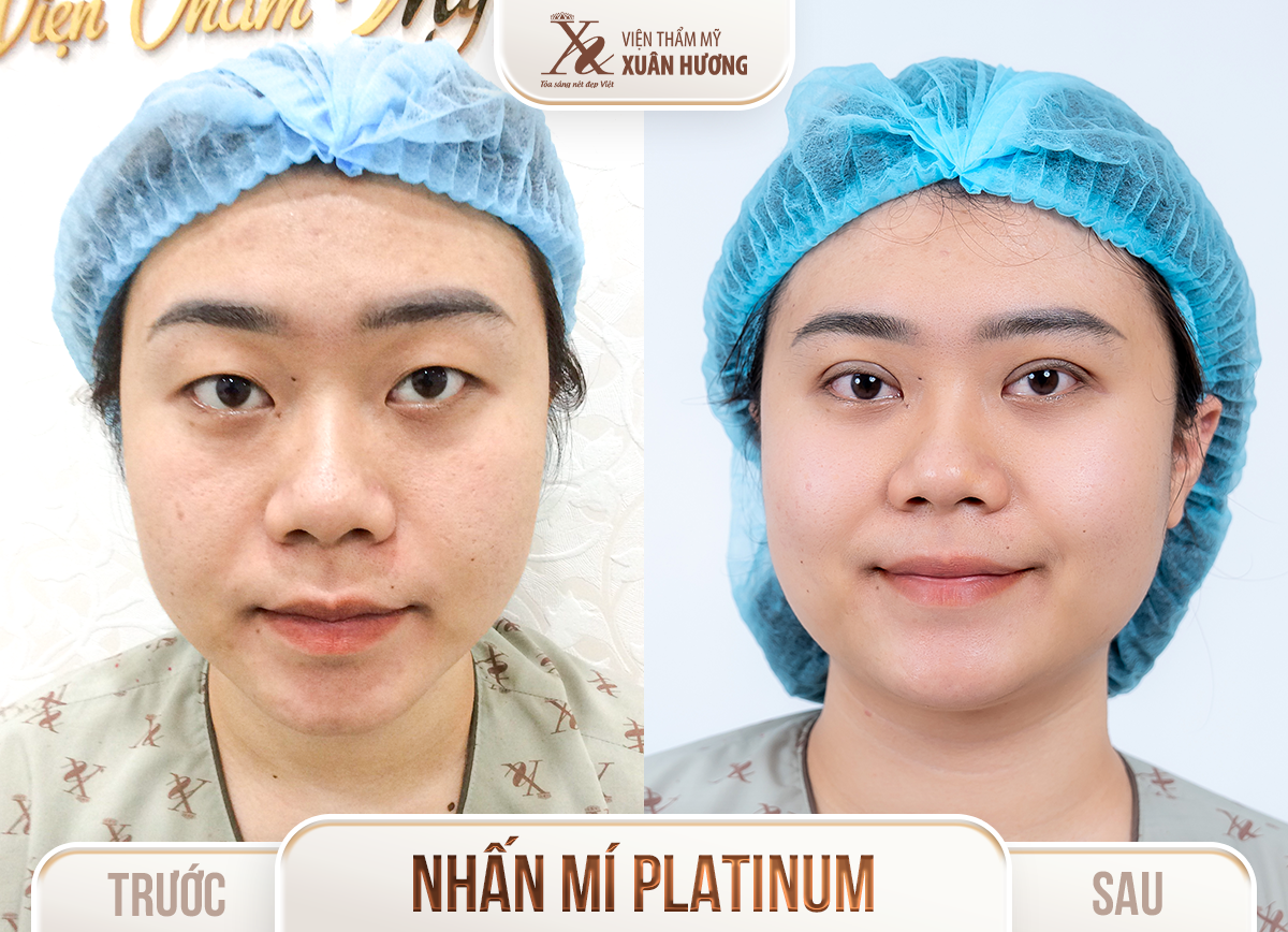 Ảnh trước sau – Phẫu thuật thẩm mỹ